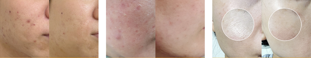 RE:BL
AC-Peel Tox Ampoule